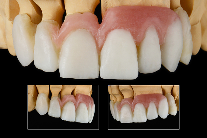 Wax-up Wax-up