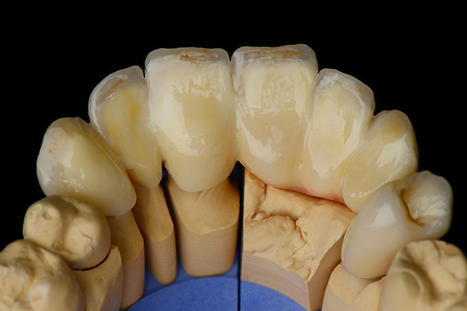 Palatal view of the anterior bridge Palatal view of the anterior bridge
