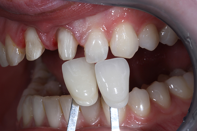 Visual comparison of the shade and the clinical situation after preparation. Visual comparison of the shade and the clinical situation after preparation.