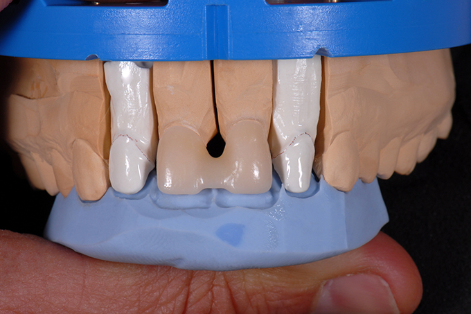 Blocked zirconium dioxide crowns Blocked zirconium dioxide crowns