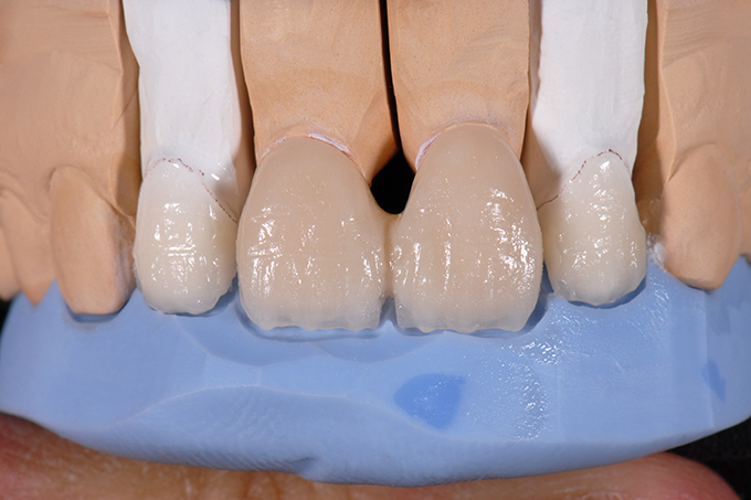 Result after the 1st dentin firing Result after the 1st dentin firing