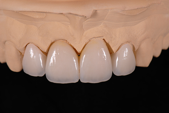The finished crowns and veneers on the model. The finished crowns and veneers on the model.