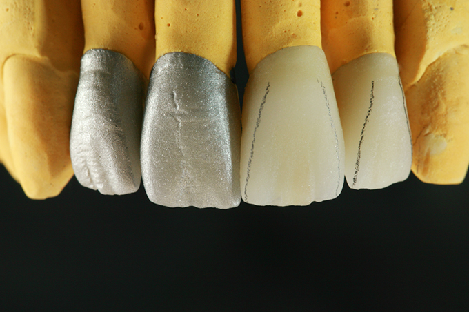 Step 9 Crowns after firing Step 9 Crowns after firing