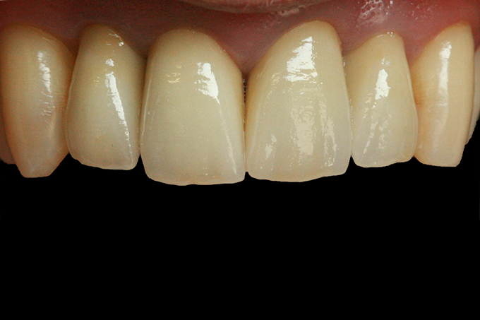 Step 10 The crowns directly following cementation Step 10 The crowns directly following cementation