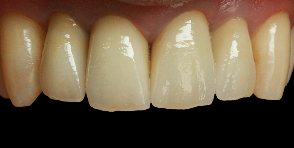 VITA patient case Urszula Młynarska. The crowns directly following cementation. VITA patient case Urszula Młynarska. The crowns directly following cementation.