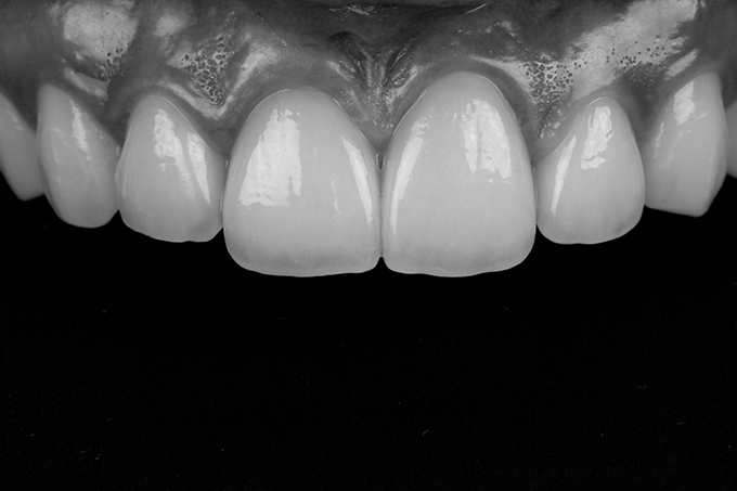 Black and white image for checking the lightness (value) of the restoration. Black and white image for checking the lightness (value) of the restoration.