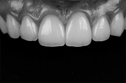 Black and white image for checking the lightness (value) of the restoration.