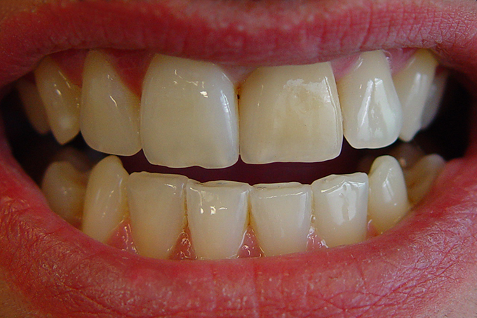Step 1 This discrepancy is often caused by incorrect tooth shade selection. Step 1 This discrepancy is often caused by incorrect tooth shade selection.