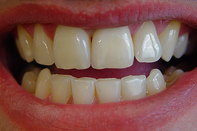 Step 5 completed crown Step 5 completed crown