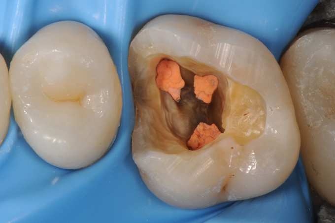 Tooth with new RCT in place Tooth with new RCT in place