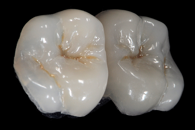 Occlusal anatomy Occlusal anatomy