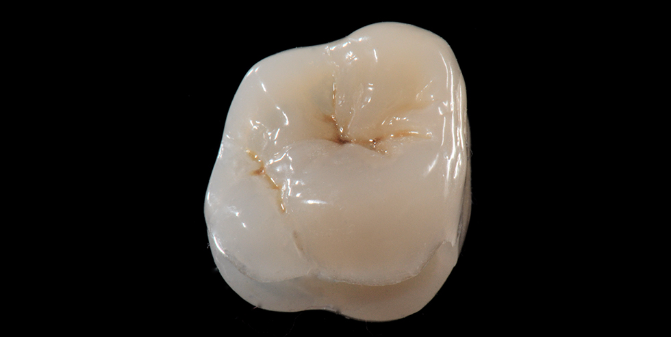 Inlay in tooth 26 made out of VITA VM LC Inlay in tooth 26 made out of VITA VM LC