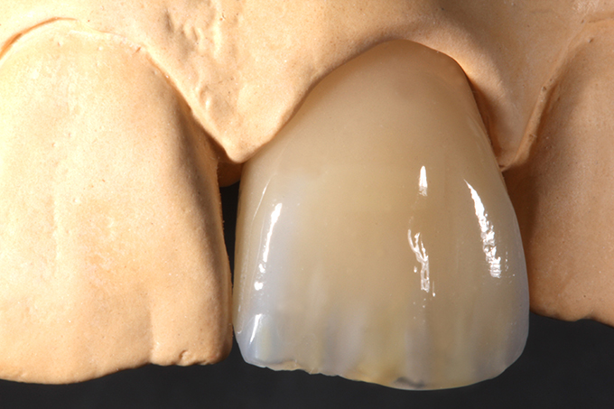VITA ENAMIC restoration VITA ENAMIC restoration