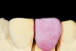 Hoàn thiện lớp mão răng bằng DENTINE 2M1 phủ lên phần cut-back.