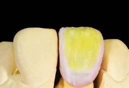 Hiệu ứng Halo từ EE2 và BASE DENTINE. Hoàn thiện với plp mỏng ENL, END và WIN.