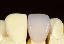 Mão răng hoàn chỉnh trên mẫu hàm sau khi nướng bóng và làm bóng.