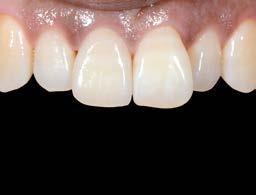 Hoàn tất phục hình trên răng 11; Bệnh nhân hài lòng với kết quả thẩm mỹ cao