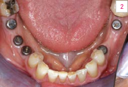 Hình 2. Răng cấy có ở khu 35 và 37 cũng như 45, 46, 47