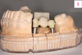 Hình 5. Cấu trúc dưới được tán từ zirconia trước khi được nhuộm màu