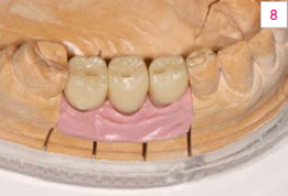Hình 8. Khoảng trống cho thân răng VITA ENAMIC IS phần tử đơn có bề mặt tích hợp, bao gồm ốc vít