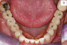 Hình 9. Tình trạng sau khi kẹp chặt toàn bộ các sửa chữa trong miệng bệnh nhân